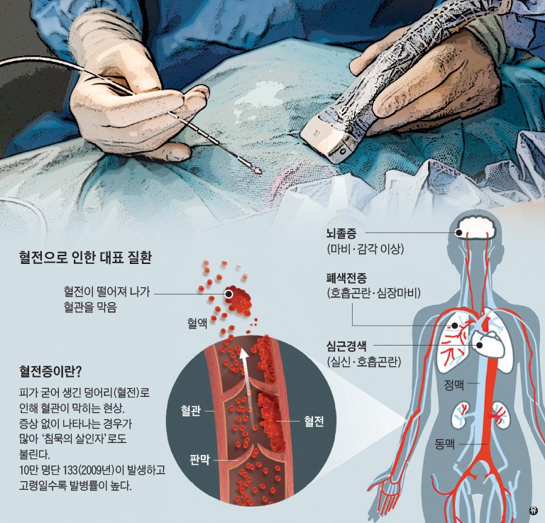 미국 - 매년 10만명 정맥혈전증으로 목숨 잃어